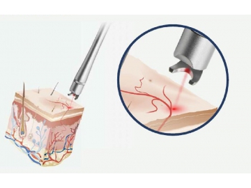 980nm Diode Laser Vascular Removal