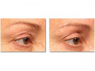 Wrinkle Removal and Skin Rejuvenation