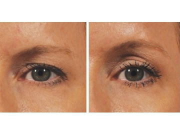 High Intensity Focused Ultrasound Facial Machine
