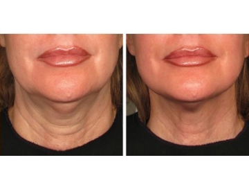 High Intensity Focused Ultrasound Facial Machine