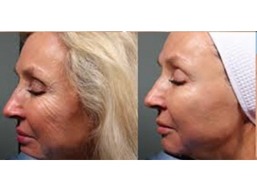 High Intensity Focused Ultrasound Facial Machine