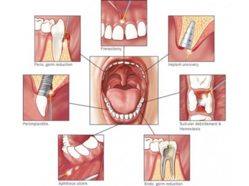 Dental Laser