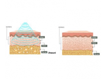 Cavitation Vacuum RF Laser Multifunction beauty Machine