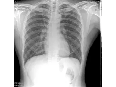 SMART Handheld X-Ray Machine