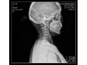 Ceiling-Mounted X-Ray Machine