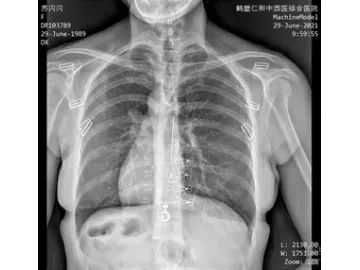 Ceiling-Mounted X-Ray Machine