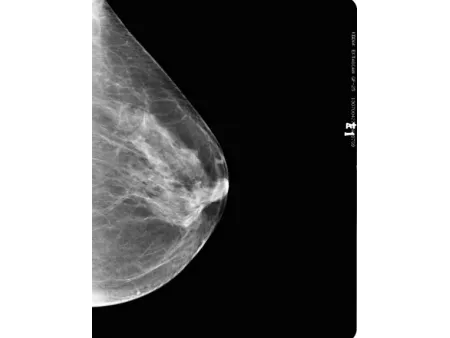 Digital Mammography System