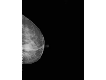 Digital Mammography System