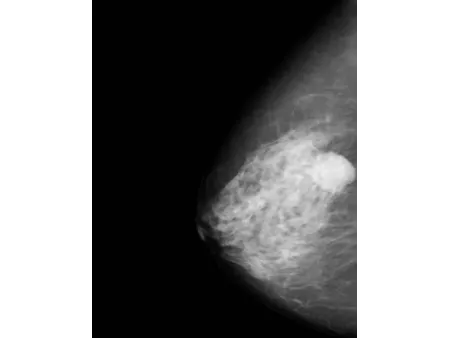 Digital Mammography System