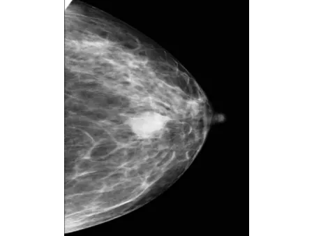 Digital Mammography System