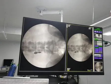Image Intensifier C-Arm Machine