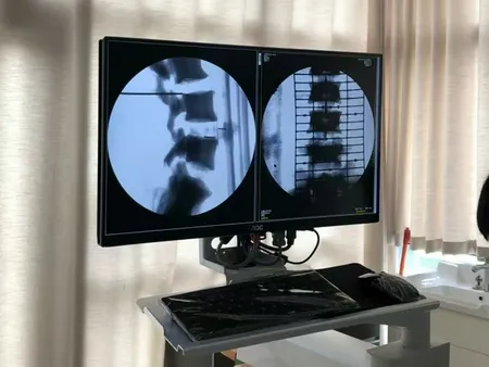 Image Intensifier C-Arm Machine