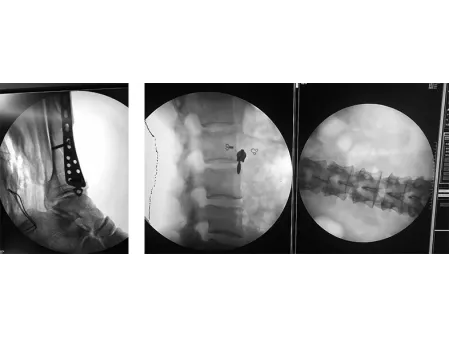 Image Intensifier C-Arm Machine