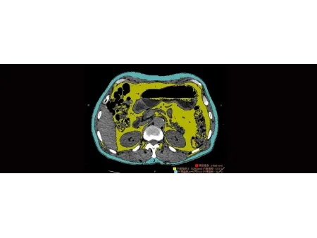 CT Scanner
