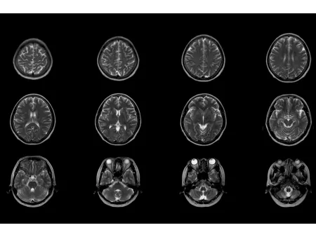 Magnetic Resonance Imaging (MRI)