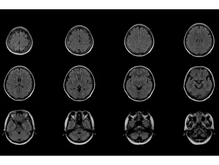 Magnetic Resonance Imaging (MRI)