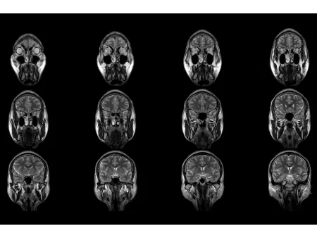 Magnetic Resonance Imaging (MRI)