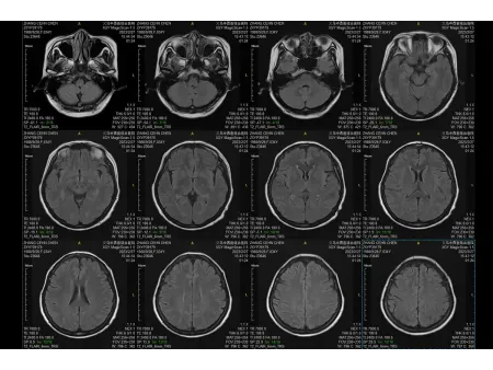 Magnetic Resonance Imaging (MRI)