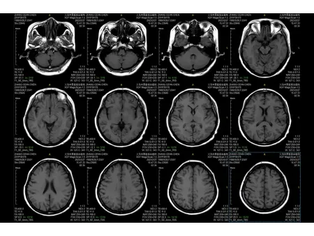 Magnetic Resonance Imaging (MRI)