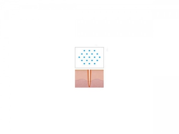 1550nm Laser for Skin Tightening, Wrinkle Removal and Scar Reduction L1550